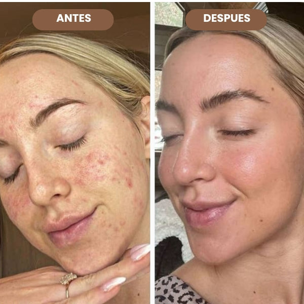 VITALSKIN™ ELIMINA PUNTOS NEGROS E IMPERFECCIONES DE TU ROSTRO EN SEGUNDOS + EBOOK DE REGALO🎁 + ENVIO GRATIS