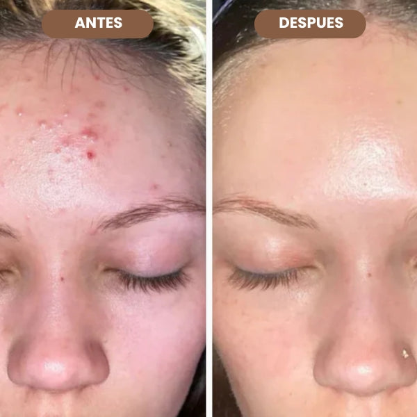 VITALSKIN™ ELIMINA PUNTOS NEGROS E IMPERFECCIONES DE TU ROSTRO EN SEGUNDOS + EBOOK DE REGALO🎁 + ENVIO GRATIS