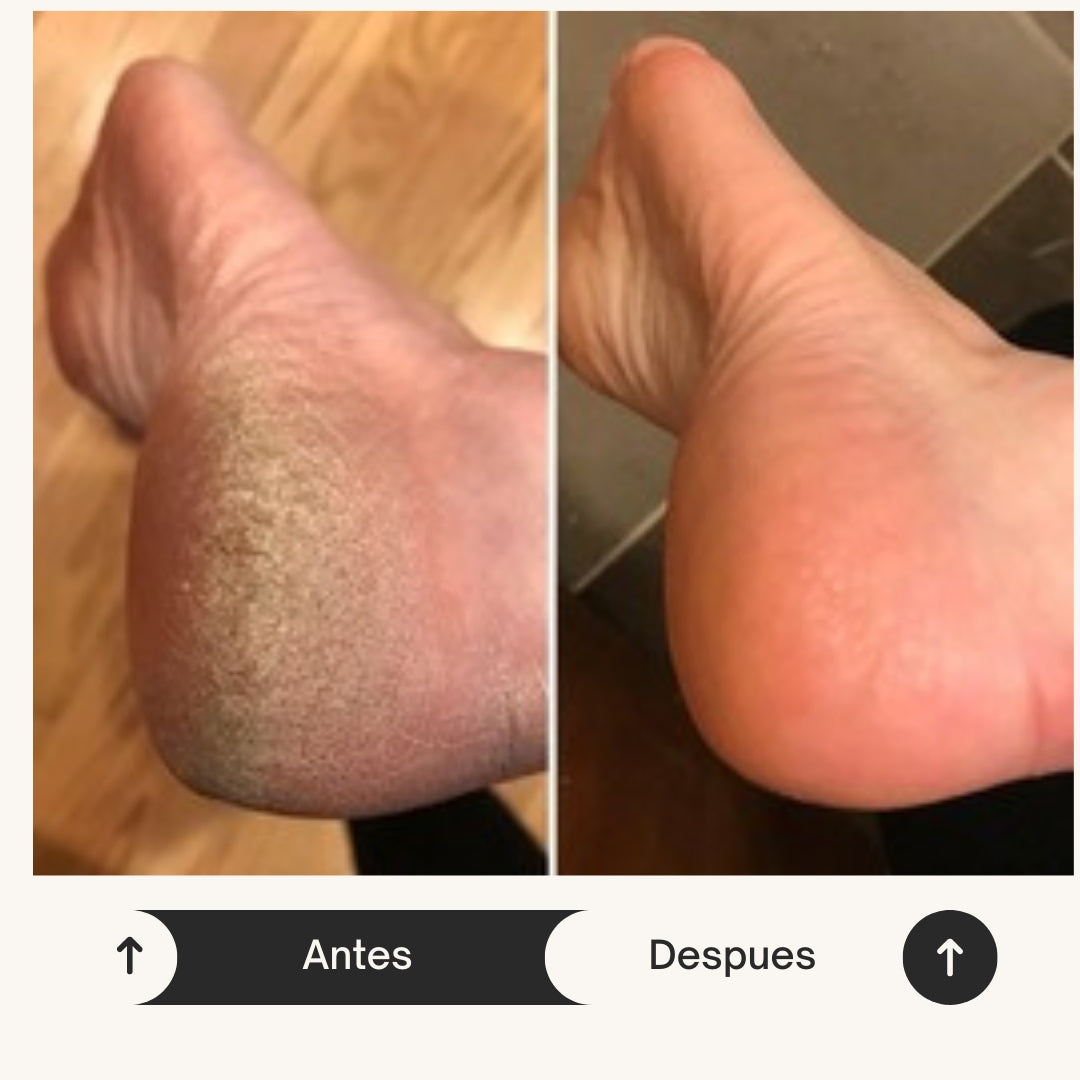 NATURAL FOOT™️ELIMINA LA RESEQUEDAD DE PIES Y MANOS EN SEGUNDOS + EBOOK DE REGALO 🎁+ ENVÍO GRATIS