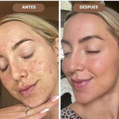 VITALSKIN™ ELIMINA PUNTOS NEGROS E IMPERFECCIONES DE TU ROSTRO EN SEGUNDOS + EBOOK DE REGALO🎁 + ENVIO GRATIS