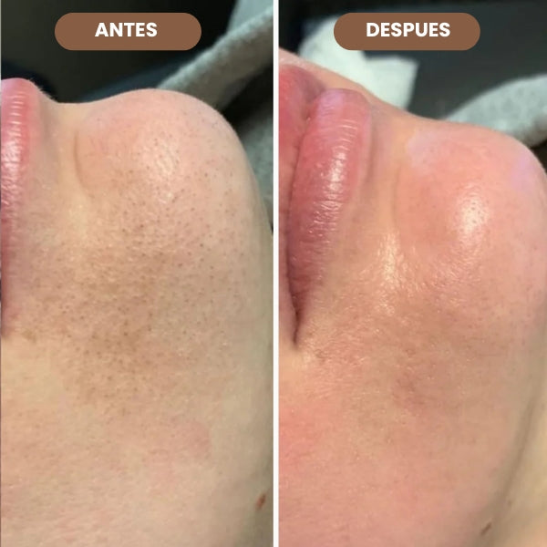 VITALSKIN™ ELIMINA PUNTOS NEGROS E IMPERFECCIONES DE TU ROSTRO EN SEGUNDOS + EBOOK DE REGALO🎁 + ENVIO GRATIS