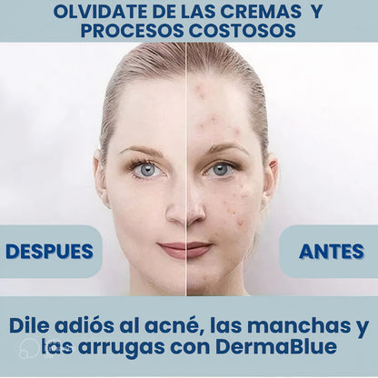 Lapíz laser facial DermaBlue™️elimina acne, manchas por el sol, y arrugas en la piel